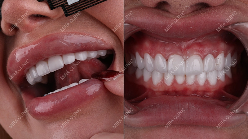 Hollywood smile Before and After